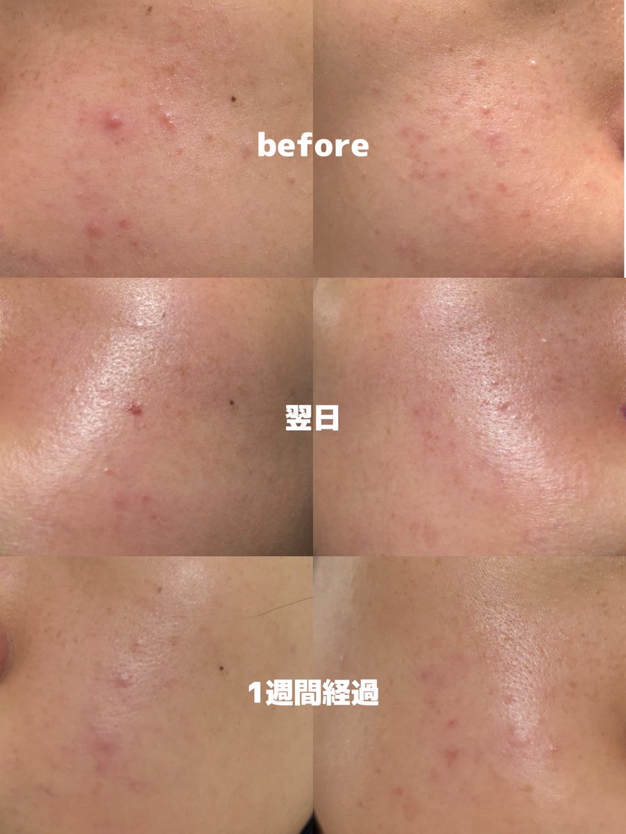 see_you_hello_'s tweet photo. ポテンツァ、ララピール、LDMから1週間が経過しました⏳

次々発生してたニキビが出来なくなった😳‼️

化粧ノリが良くなって、メイク楽しい🎵

まだ肌の薄いところは針��ポツポツが残ってる印象あるかな、目の下とか眉間とか

このポツポツが引くころに赤みも落ち着いてくれるといいなぁ😚 https://t.co/CcEBsSLU0O
