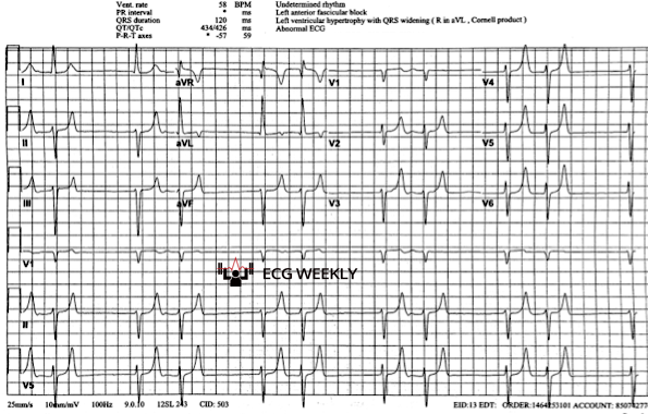 A52-year-old woman presents to the emergency department with weakness. The following ECG is obtained......ecgweekly.com/weekly-workout…