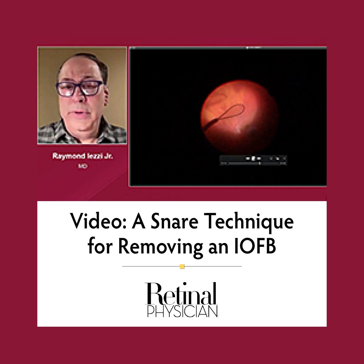 Raymond Iezzi Jr, MD, demonstrates a snare technique for removing an intraocular foreign body. View here: ow.ly/NnFQ50Wttu1
#Retinalphysician #retinasurgery #surgicalvideo #IOFB #Conexiant