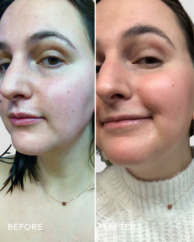 SkinHero™ Calendula + 2% Bakuchiol Bio-Retinol Serum
Get more : xily.pro/KnFJl

#skincare #SkinCareRoutine #skincaretips #skincaregoals #beauty #usa #canada #SkincareEssentials #skincareproducts