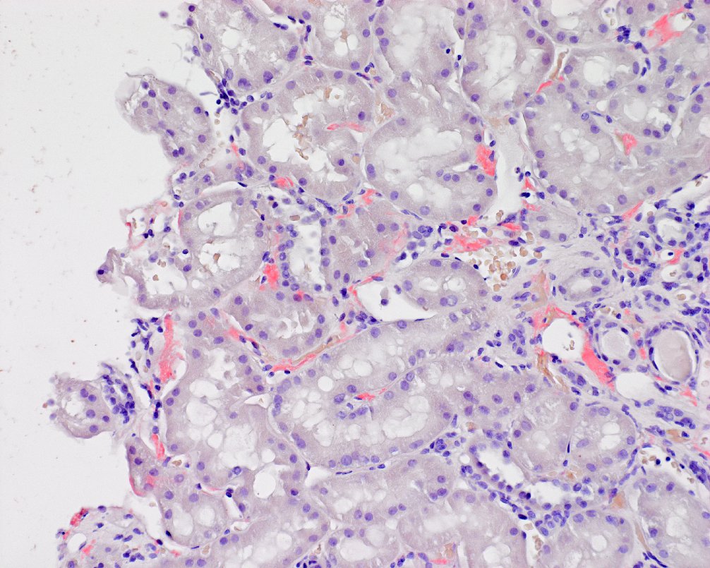 What would be your leading Dx and subtype based on the Congo red image above showing deposition predominately in the cortex of a Hispanic patient?

#DiagnoseThis #pathology #renal #kidneypath