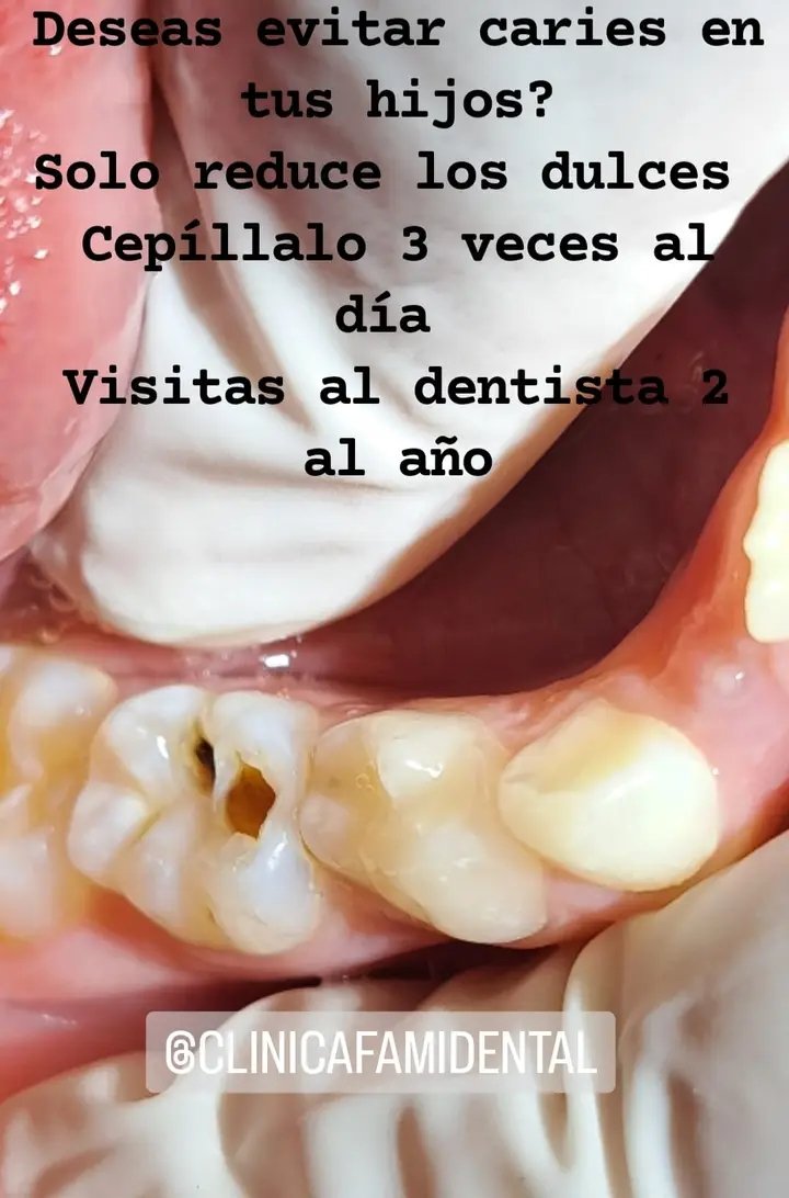 El tiempo lo sana y calma  todo....🕘
menos las caries.🙏
Lo peor para una caries es el tiempo,😱🦷 porque a mayor tiempo más agresiva se vuelve.🫥
 Visita al dentista 2 veces por año para curarlas a tiempo 🫡