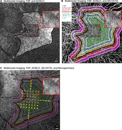 Liangbo Linus Shen et al. <a href="/LinusShenMD/">Linus Shen, MD</a> <a href="/UCSF/">UC San Francisco</a> share their Longitudinal Assessment of Cone Structure, Choriocapillaris, and Retinal Sensitivity in Choroideremia, iovs.arvojournals.org/article.aspx?a….