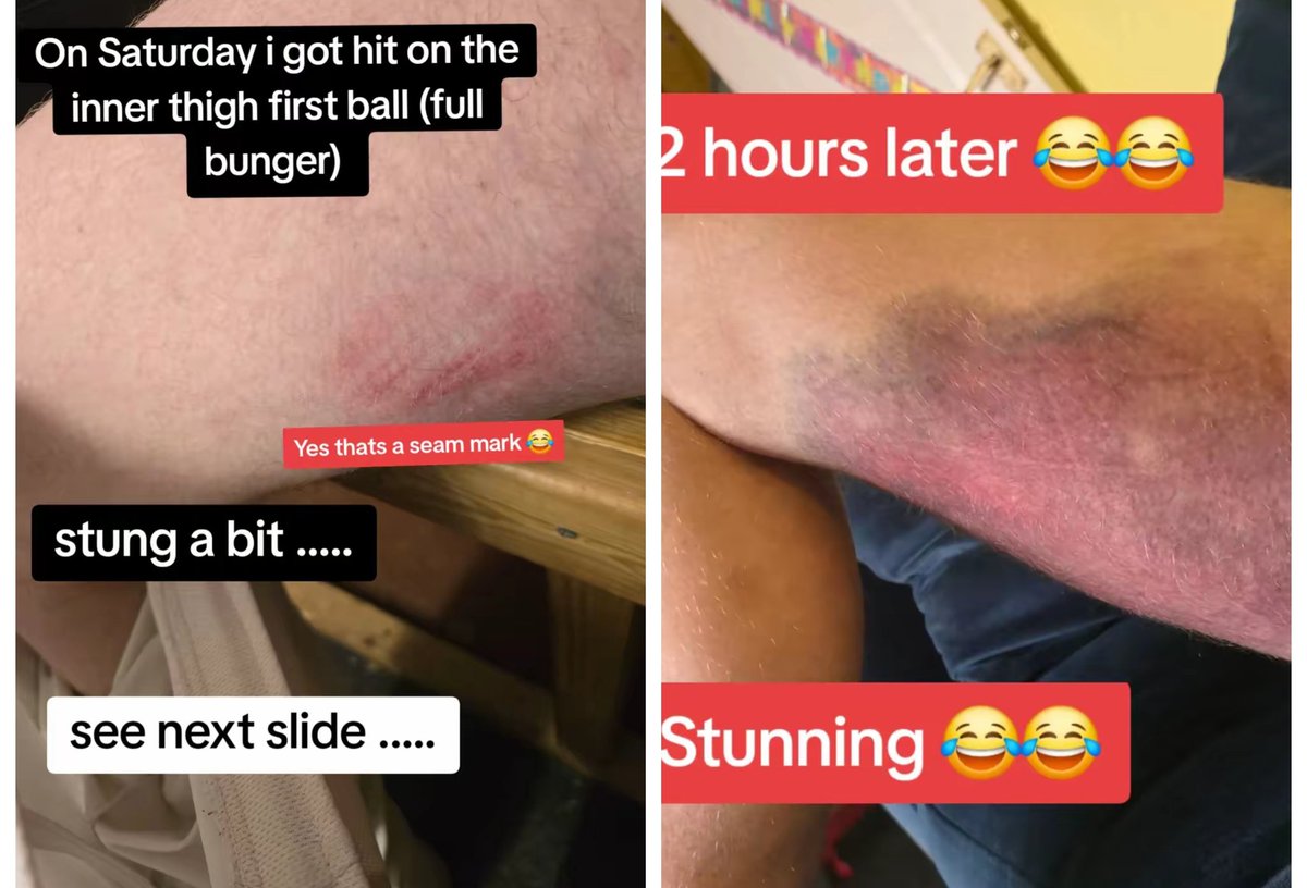 This cricket hobby of mine hurts at times 😂 
And to think they had a 50% chance of hitting my prosthetic 😂