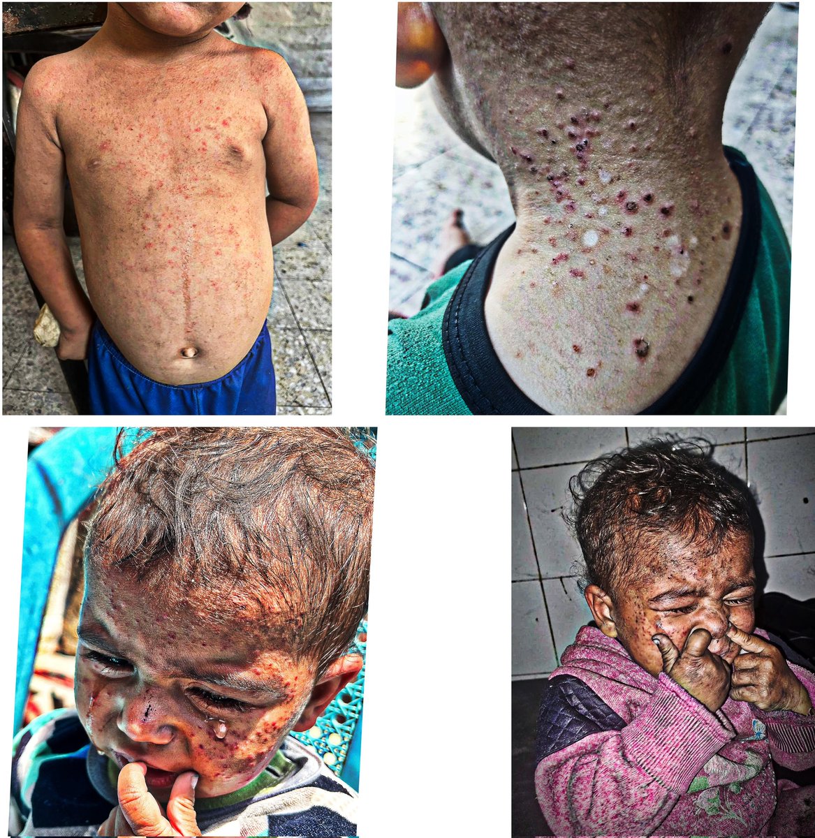 Save us people . Please don't ignore me . Joud and her brother Snd her brother feel a burning sensation and severe pain . The children of Gaza suffer from serious skin rashes and their health is deteriorating more than before, and they need you . Be the reason for their recovery.
