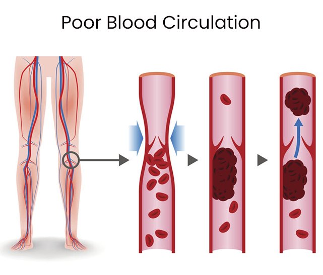 ضعف الدورة الدموية يستنزف طاقتك بصمت ويدمر صحتك.

يتجاهل معظم الناس هذه العلامات حتى فوات الأوان...

إليك ما هو، ولماذا هو خطير، وكيفية علاجه (قبل أن يُدمر حياتك):