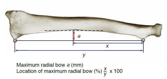 MoAImam's tweet photo. The method of Schemitsch and Richards for quantifying the maximum radial bow and its location relative to the length of the entire radius https://t.co/TZk6CMHckr