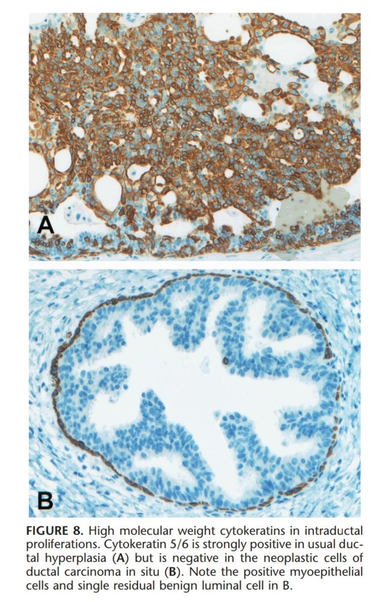 NicoloVianini's tweet photo. HMWCK in intraductal proliferations.
CK5/6 in UDH (A) vs CK5/6 in DCIS (B)
#UniVR #BreastPathology #IntraductalProliferations https://t.co/QUIpg0Bavk