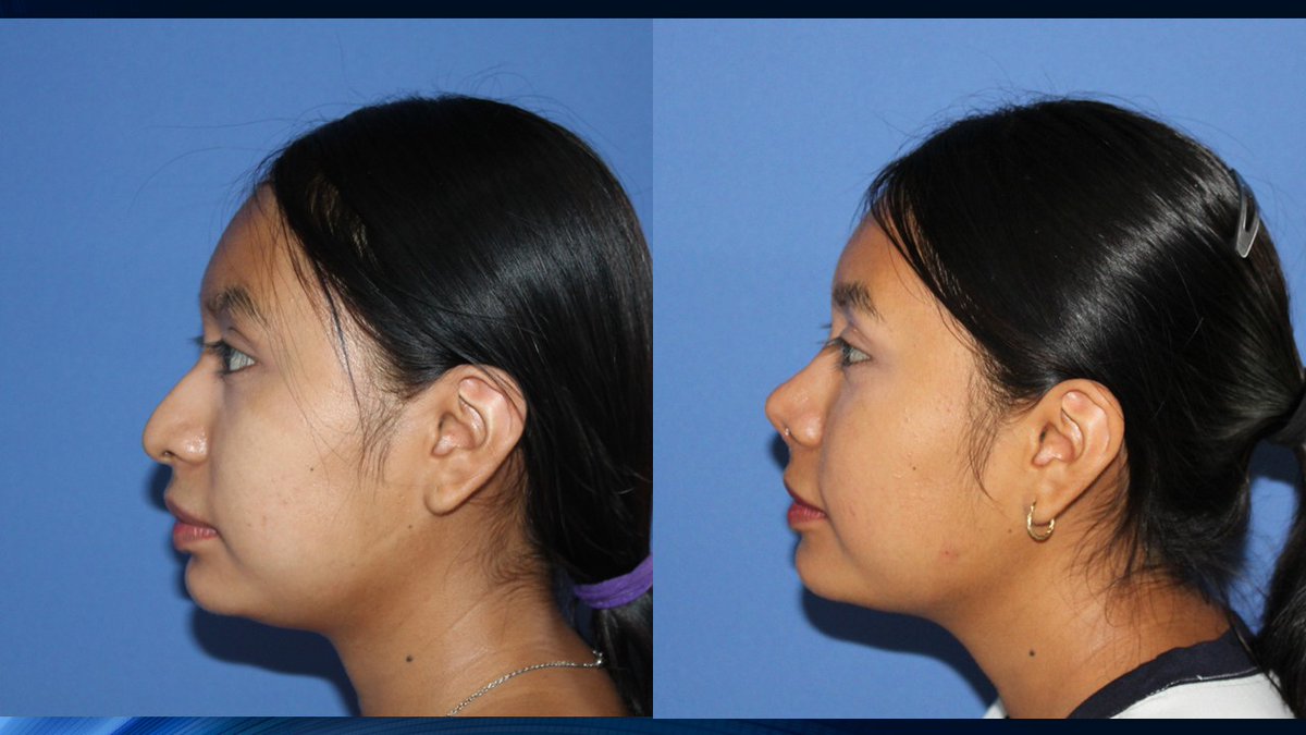 jesusgodinez's tweet photo. Rinoplastia en piel gruesa,  #doctorjesusgodinez, #cirugiafacialgodinez, #rinoplastiasegura, #rinoplastia, #resultadospermanentes, #elresultadoesindividual, https://t.co/XYOAXSek48