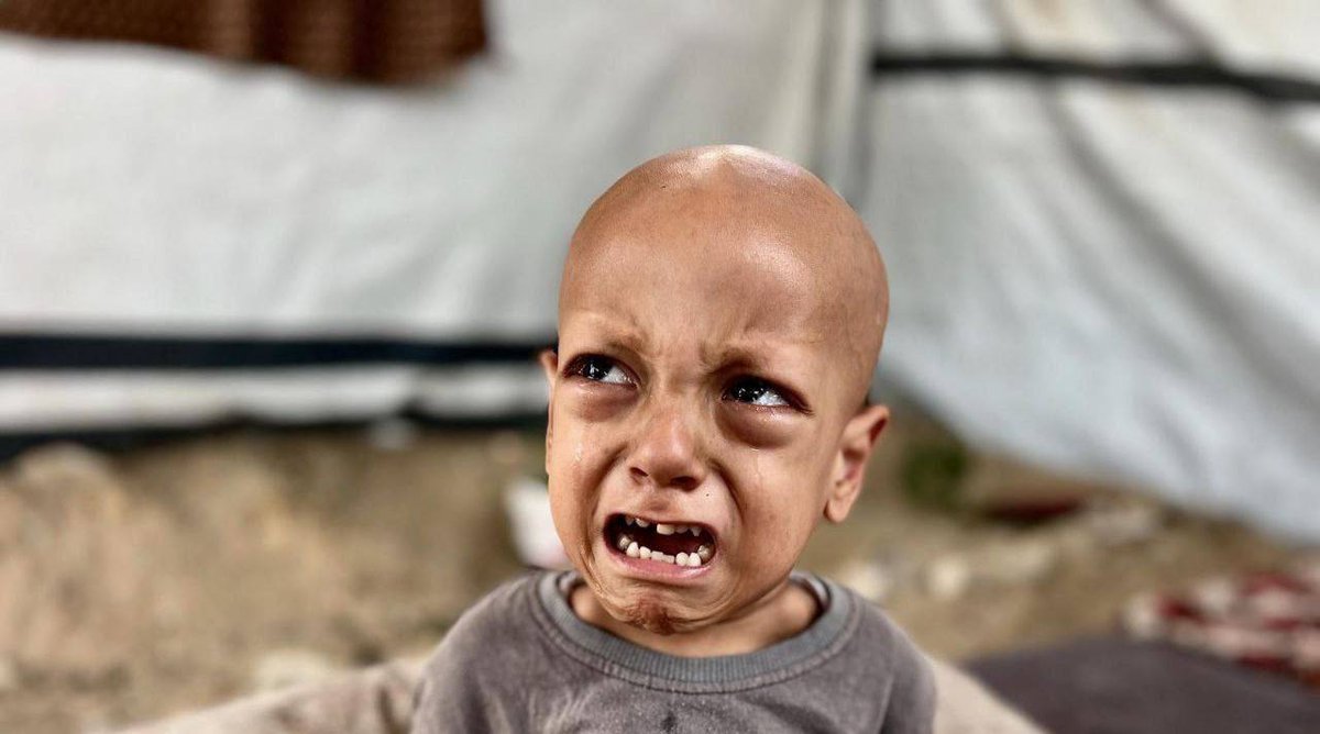 The child from the "I am hungry in Gaza" photo has now died due to severe hunger.