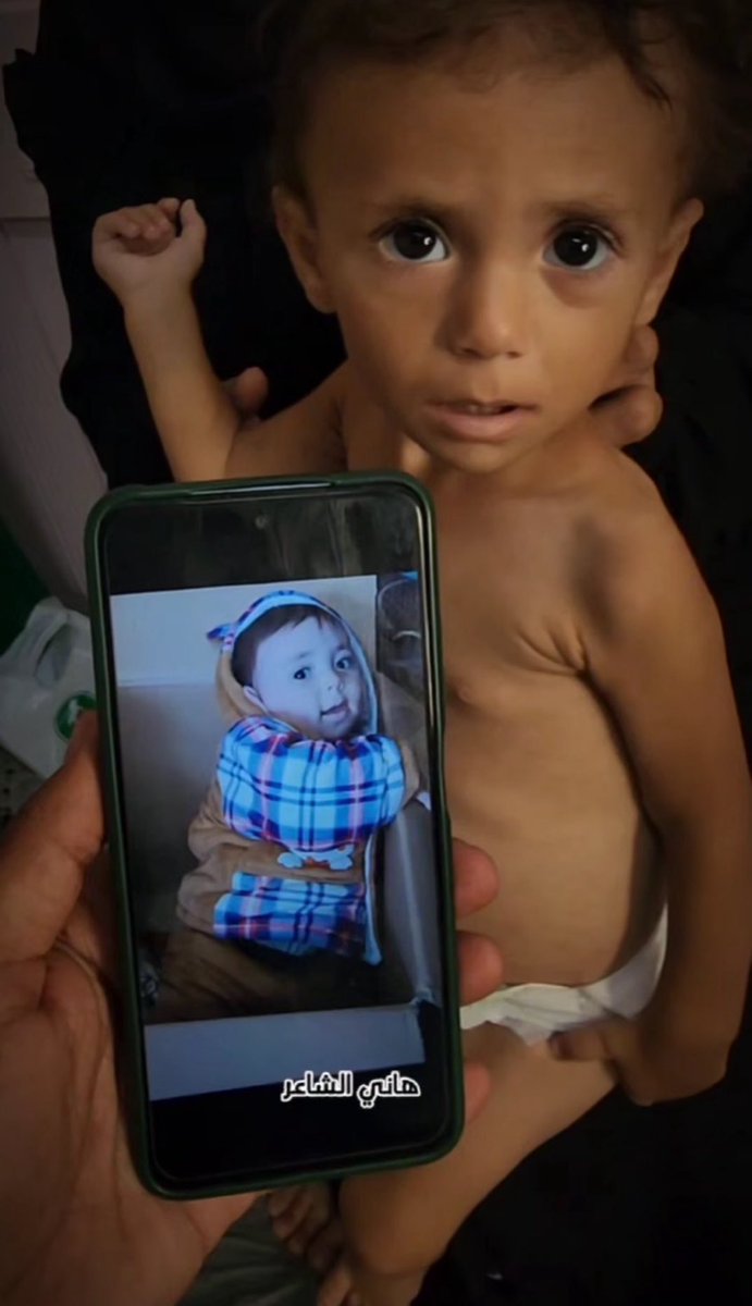 Hazaar Arafa… a story of starvation and malnutrition.
In a group where mothers share photos of their children before and after Israeli-imposed starvation, I was struck by this child’s gaze, as if he were silently asking the world, “Why??”