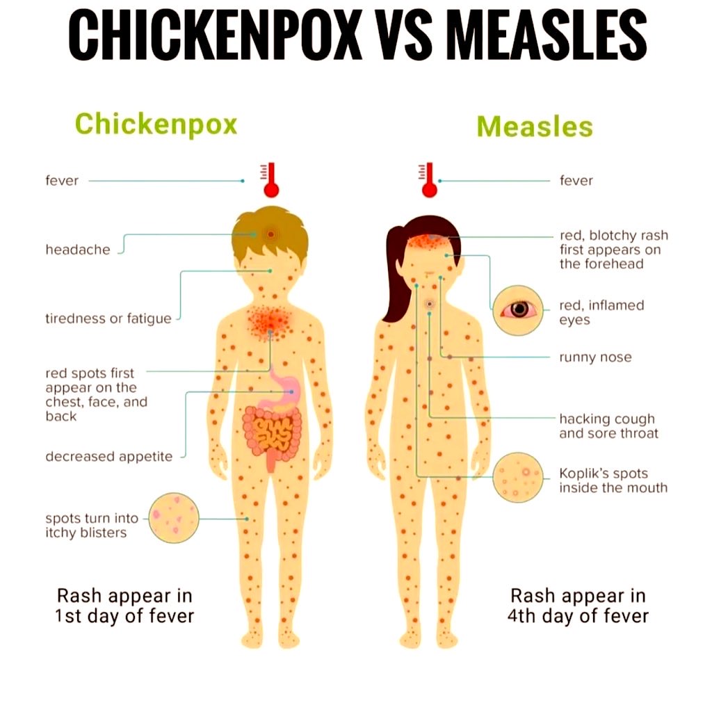 Doctors__squad's tweet photo. CHICKENPOX VS MEASLES https://t.co/IYGD0ui1p6