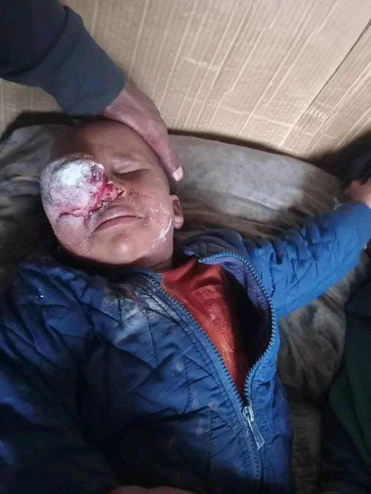 A mother is urgently asking for help for her 4-year-old son, who has a blind eye. The situation has worsened — the eye is now swollen and is becoming life-threatening. He developed this around June.

Despite multiple hospital visits, the boy has received little to no help.

If