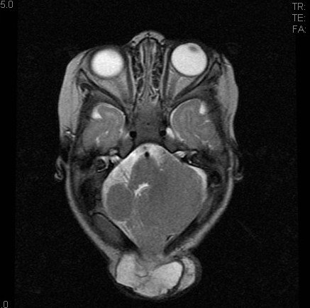 3型もあるぜ！
キアリ奇形3型

☑後頭部に大きな脳隆人小脳・脳幹が嵌入
☑非常に稀で随伴奇形も多く、予後は他の方と比べると不良
☑4、5型もあり、なんなら0、1.5、3.5とかもある（ただし一部は廃止されてたりもする）

Radiopedia rID:5781, rID:17478
#Rdiag