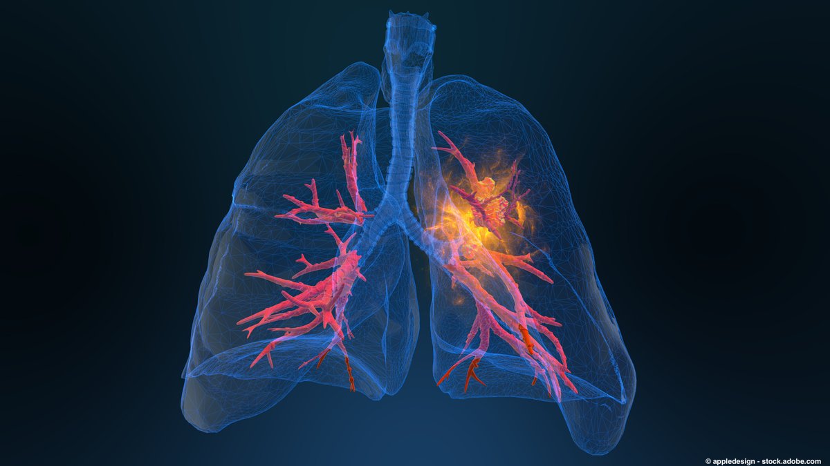 Following the development of crizotinib, newer generations of drugs have shown improved efficacy and reduced toxicity for patients with ROS1+ #NSCLC, allowing for more personalized treatment. <a href="/nievamd/">Jorge Nieva</a> <a href="/KECKSchool_USC/">Keck School of Medicine of USC</a> #LCSM
Read here: hubs.ly/Q03Ddx5x0