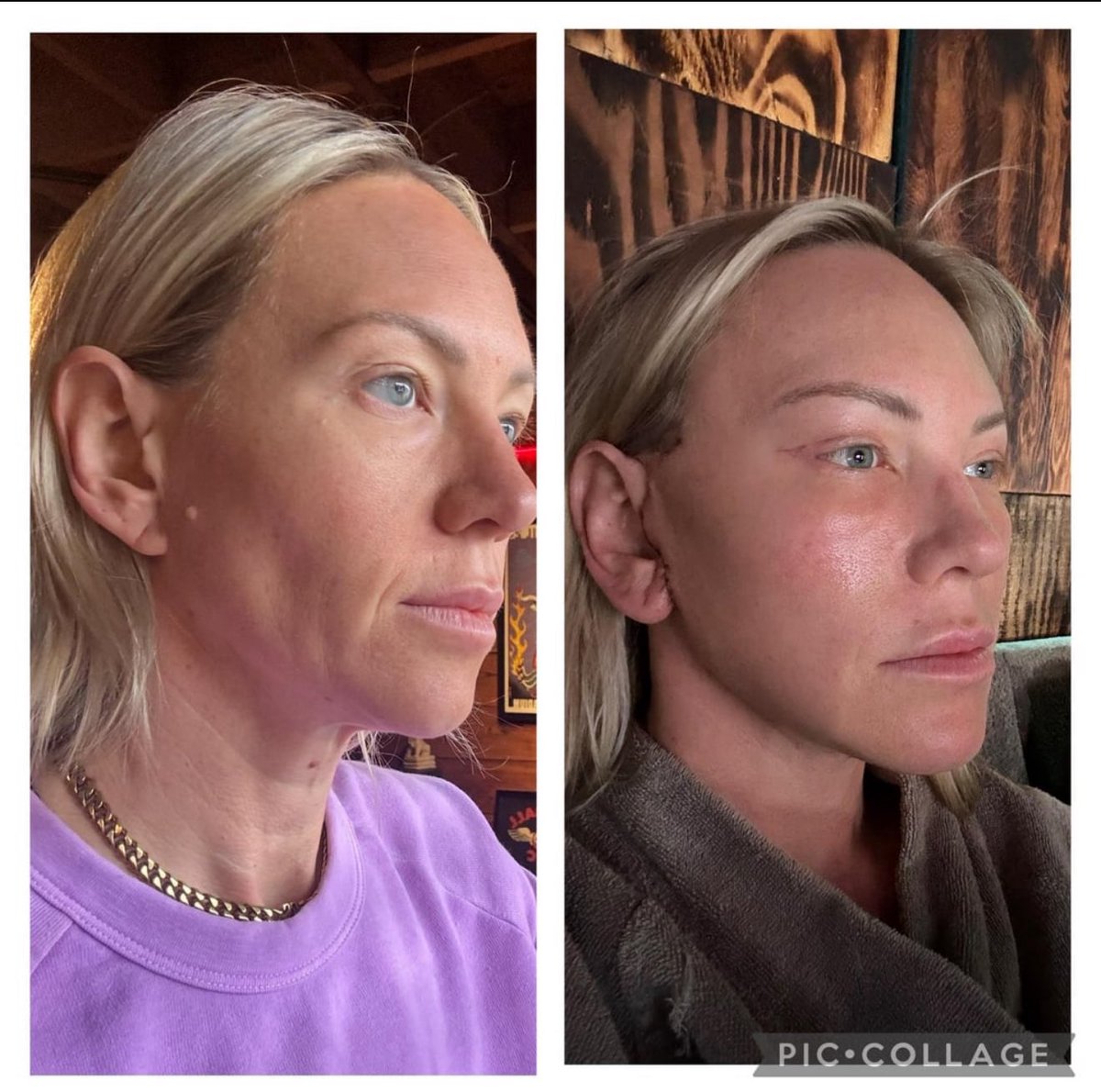 Real patient experiences matter most. One of my facelift patients shared her honest journey on Reddit — from 2 weeks to 6 weeks after a deep plane face + neck lift.

#Facelift #DeepPlane #PlasticSurgery #BeverlyHills

reddit.com/r/PlasticSurge…
