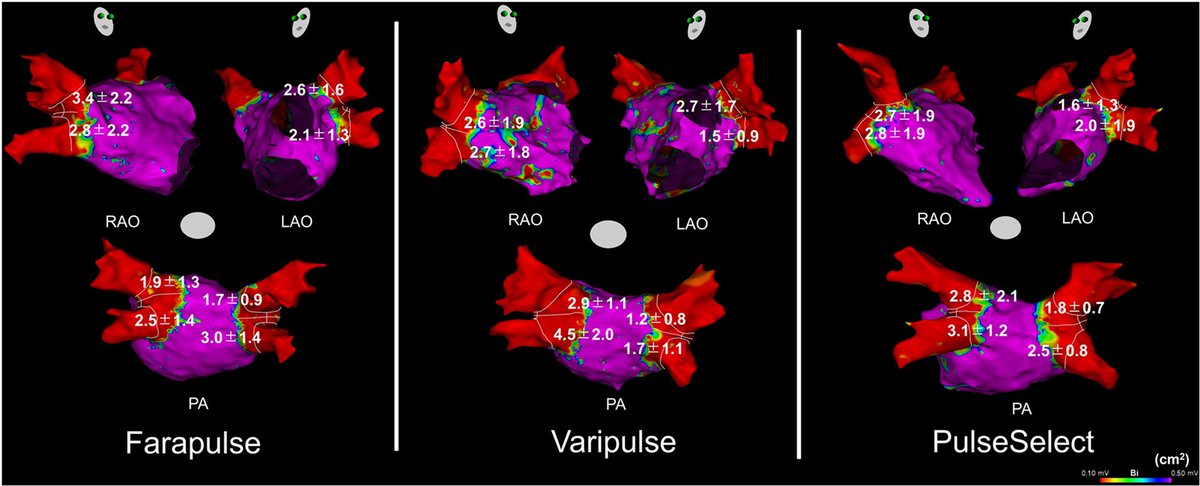 Radosław Lenarczyk (@rlenarczyk) on Twitter photo Curious how the three #PFA systems compare?👇
heartrhythmjournal.com/article/S1547-…
<a href="/RolandTilz/">Roland Tilz</a>
<a href="/ftrae/">Piotr Futyma, MD</a>
<a href="/EuropaceEiC/">Europace Editor-in-Chief</a> <a href="/DanielScherr3/">Daniel Scherr</a> <a href="/ehj_ed/">EHJ Editor-in-Chief</a> Curious how the three #PFA systems compare?👇
heartrhythmjournal.com/article/S1547-…
<a href="/RolandTilz/">Roland Tilz</a>
<a href="/ftrae/">Piotr Futyma, MD</a>
<a href="/EuropaceEiC/">Europace Editor-in-Chief</a> <a href="/DanielScherr3/">Daniel Scherr</a> <a href="/ehj_ed/">EHJ Editor-in-Chief</a>