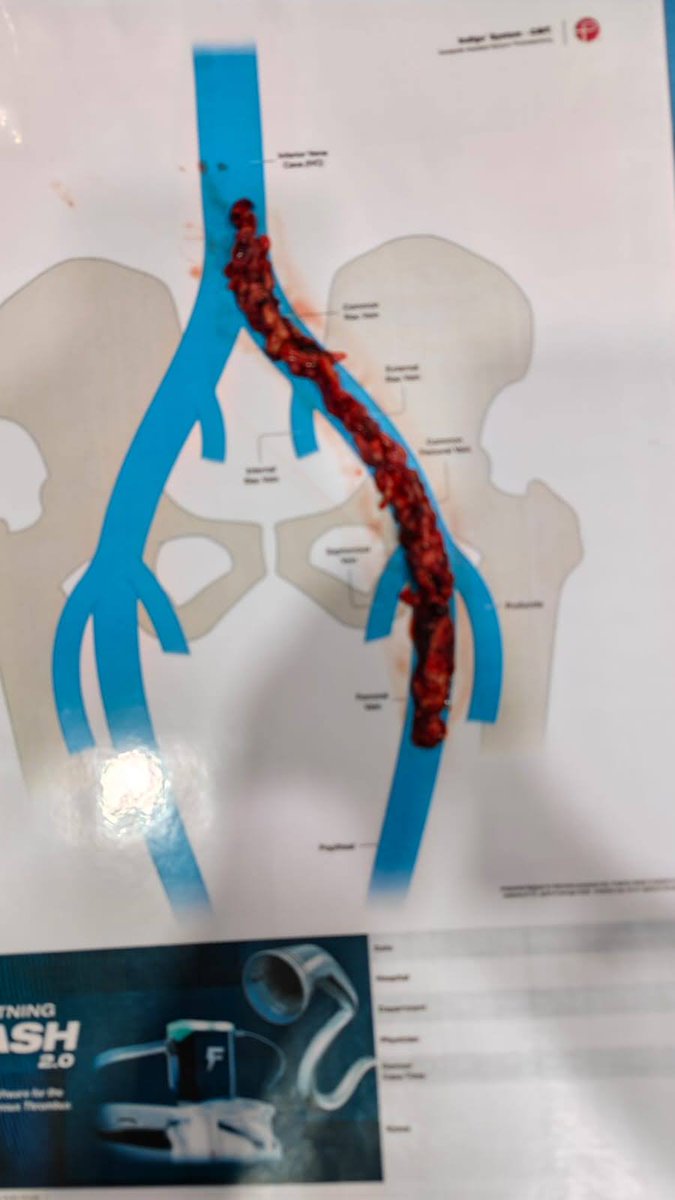 VascularClinics's tweet photo. And out it comes 
@farkomd @VarenyamVasc @Fortisnoida @vascularsrgn @yuejianing @VascularForum https://t.co/V1Jv8Z6jg6