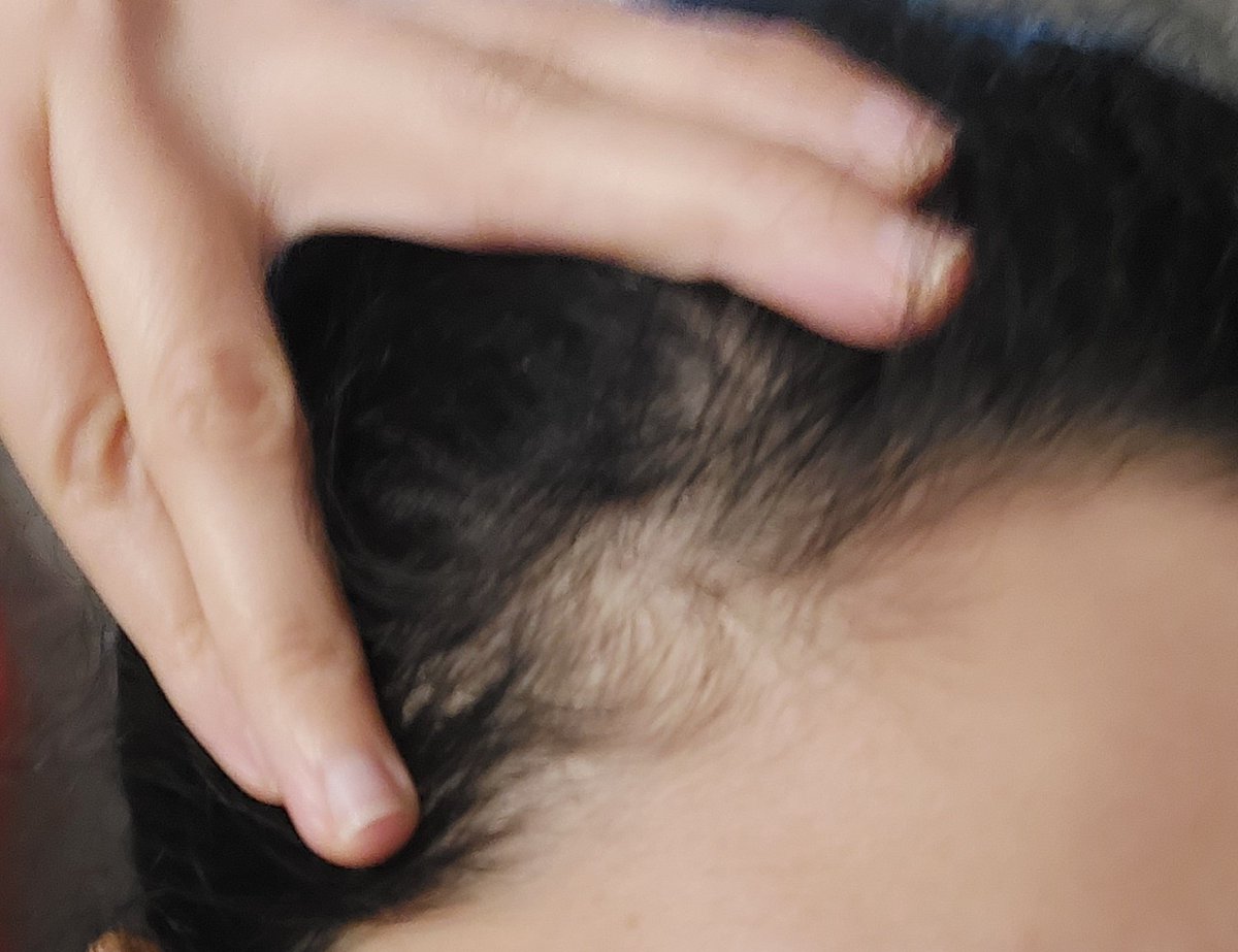 Windsofchange72's tweet photo. I had horrific hair fall and bald patches although I'm quite young.

11 yrs of Hypothyroidism &amp; now I'm free of this life wrecking ailment.

Now I have thick full hair and the bald patches are gone. 

Thanks to 👇🏻
>Linorma T3 - Life saving miracle
>Ray Peat - Absolute Genius https://t.co/OKby6BynmD