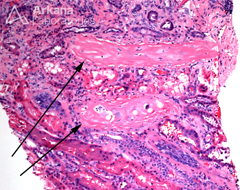 Today’s teaching point is a true “zebra” in renal pathology. The arrows in the light microscopic image identify what have been called renal sclerosing peritubular nodules, which are foci of peritubular spindle cells with myofibroblastic differentiation and variable amounts of