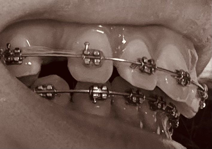 約1ヶ月前に調整してきて今こんな感じ
ゴムで後ろに4番引っ張ってる
左特に動くの早い
左⬅️         ➡️右