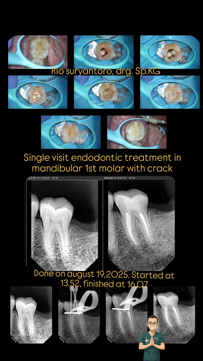 Single visit endodontic treatment in mandibular 1st molar with crack
Done on august 19,2025. Started at 13.52, finished at 16.07