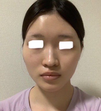 セギムで輪郭3点して8ヶ月!
経過観察の時にCT撮ってもらったけど、しっかり頬骨くっついてた✨でもまだDT中だからさらに顔小さくなるよって言ってもらえて大歓喜😭🫶今後の経過も楽しみ!
←整形前(鼻も未整形)
輪郭3点DT8ヶ月→ https://t.co/DiXMZgl3cl