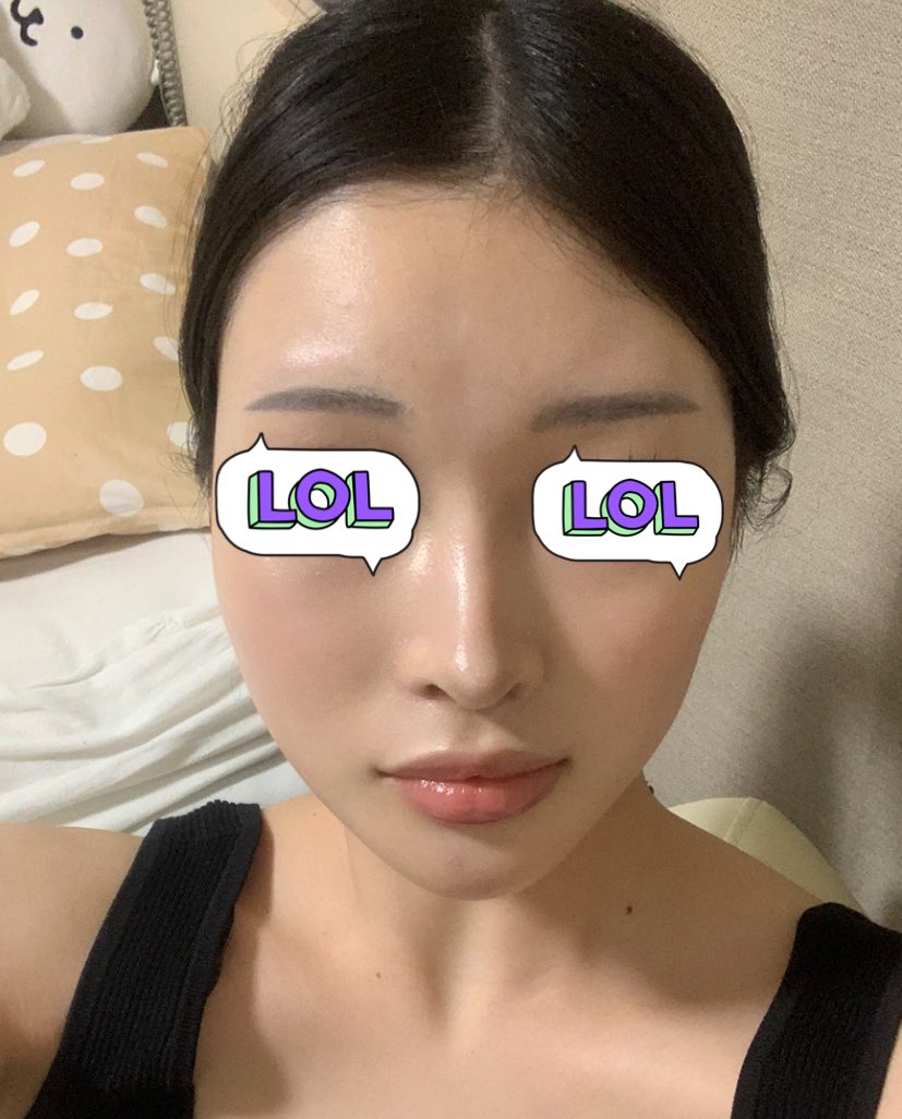 セギムで輪郭3点して8ヶ月!
経過観察の時にCT撮ってもらったけど、しっかり頬骨くっついてた✨でもまだDT中だからさらに顔小さくなるよって言ってもらえて大歓喜😭🫶今後の経過も楽しみ!
←整形前(鼻も未整形)
輪郭3点DT8ヶ月→ https://t.co/DiXMZgl3cl