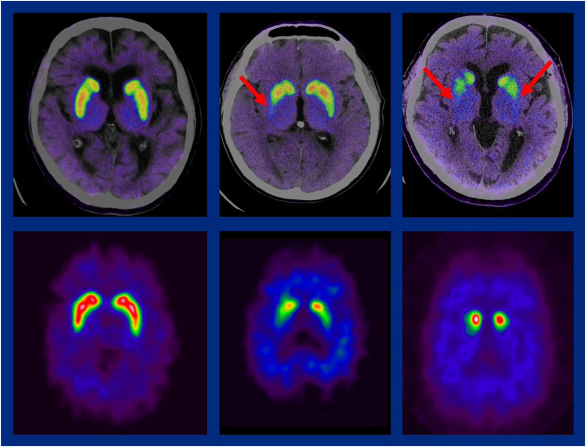 JournalofNucMed's tweet image. SNMMI 2024 Highlights Lecture: Neurosciences. ow.ly/pYXm50WyZoi

#NuclearMedicine #MolecularImaging #Neuroscience