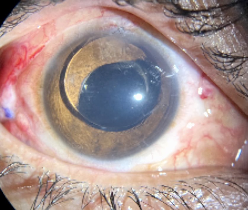 Silicone Oil in Anterior Chamber

1️⃣ Shiny globules in AC = silicone oil alert!

2️⃣ Think glaucoma – oil blocks trabecular meshwork.

3️⃣ Endothelial kiss → corneal decompensation.

4️⃣ Inferior iridectomy prevents oil migration.

5️⃣ Oil in AC = time to plan removal.

#retina
