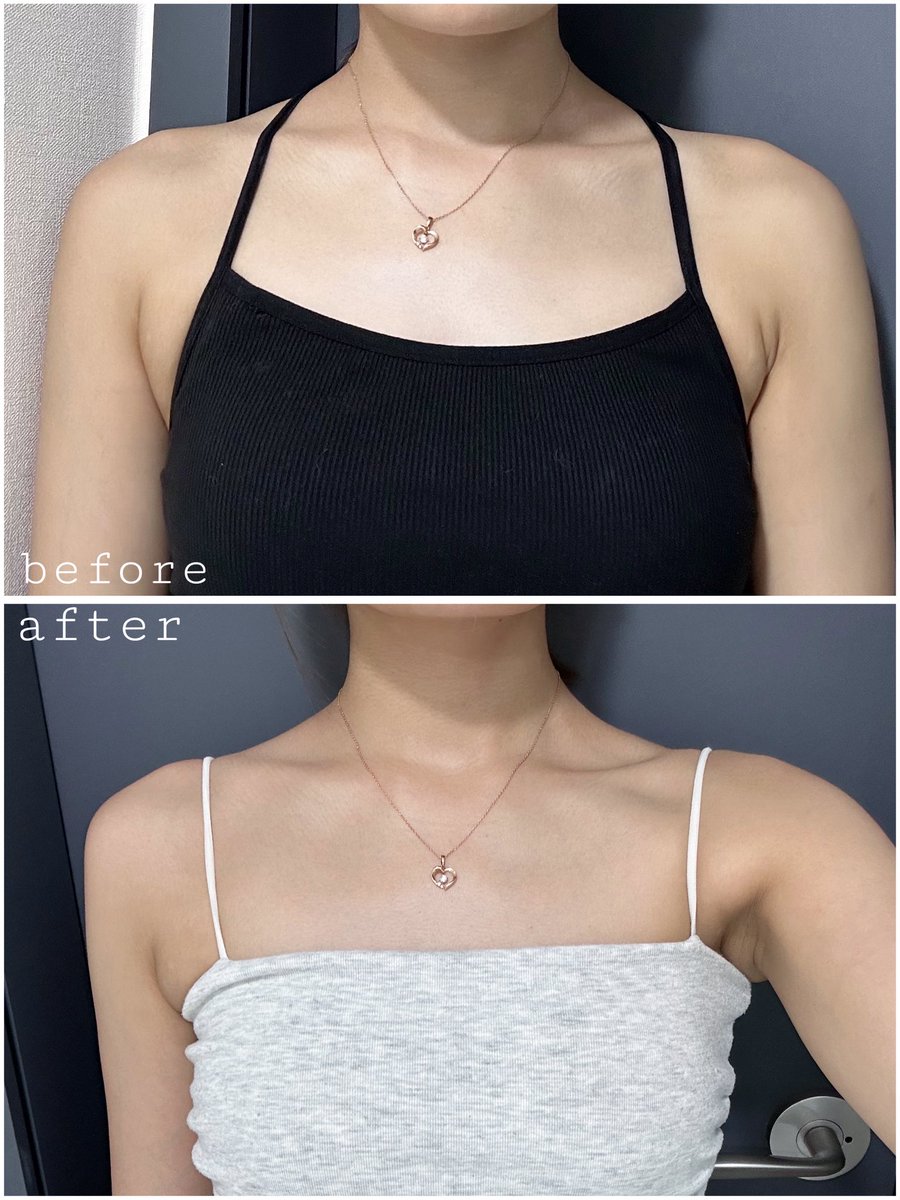 マイン美容外科(<a href="/jpmineplastic/">マイン美容外科・皮膚科</a> )で肩ボト+スリムネック注射受けてから2週間程経ったので経過レポ✨

肩のハリがやわらいで、デコルテから首にかけてすっきり見えるように。姿勢も自然ときれいに見えて、シルエットが変わったのを実感しています😌