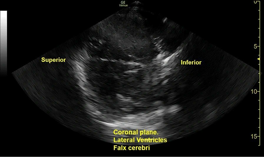 Transcranial ultrasound in the critically ill patient: a narrative review

CCR Journal Watch - tracking the critical care literature daily
criticalcarereviews.com/latest-evidenc…