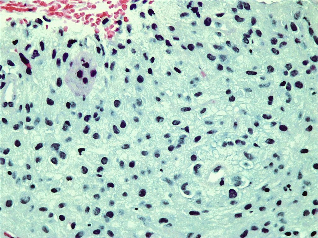 Citopatoroxx's tweet photo. This is the block cell. 
 Sheets with epitheliod cell morphology admixed with spindle cells. DOG1 and CD117 positive: GIST. 
What tips can you add for the diagnosis of this tumor? https://t.co/GHKNubf7TD