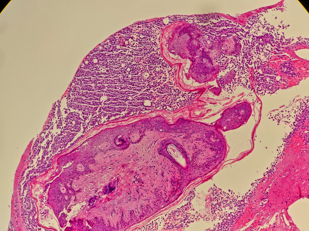 MirunaPopescu13's tweet photo. Pleural fluid cytoblock in a patient with known history of esophageal carcinoma.
What could this be? 🧐

#PathTwitter #cytopath https://t.co/C2yx88wmqg