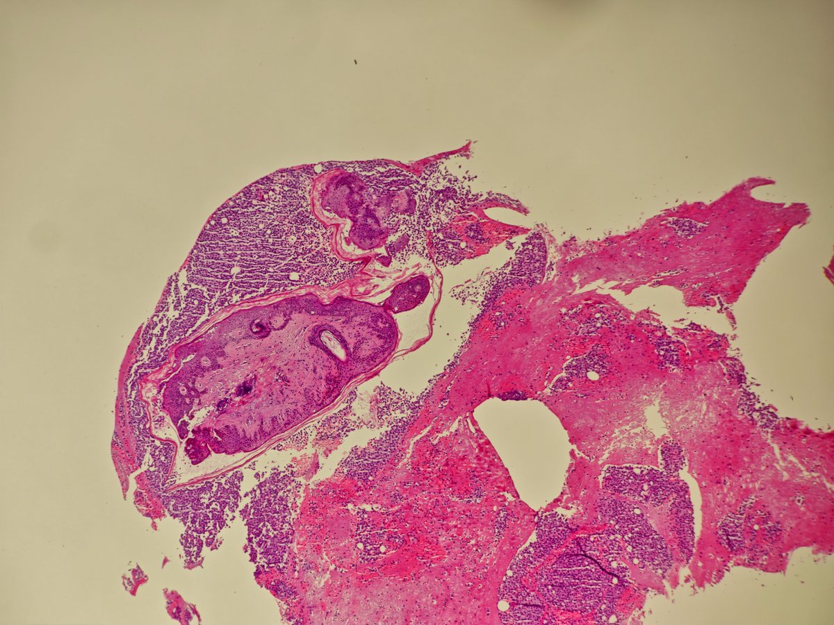 MirunaPopescu13's tweet photo. Pleural fluid cytoblock in a patient with known history of esophageal carcinoma.
What could this be? 🧐

#PathTwitter #cytopath https://t.co/C2yx88wmqg