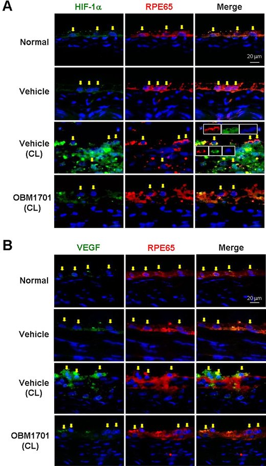 TVST Journal (@arvotvst) on Twitter photo Yeou-Ping Tsao et al. show that OBM1701 Alleviates Choroidal Neovascularization in Experimental Animals Via Suppressing the Expression of HIF-1α in Retinal Pigment Epithelial Cells, tvst.arvojournals.org/article.aspx?a…. Yeou-Ping Tsao et al. show that OBM1701 Alleviates Choroidal Neovascularization in Experimental Animals Via Suppressing the Expression of HIF-1α in Retinal Pigment Epithelial Cells, tvst.arvojournals.org/article.aspx?a….