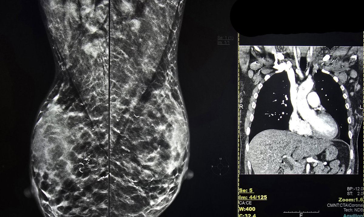 PromedicaR's tweet photo. Lymphoma with axillary nodes on mammo https://t.co/xdfNiIS6Gu