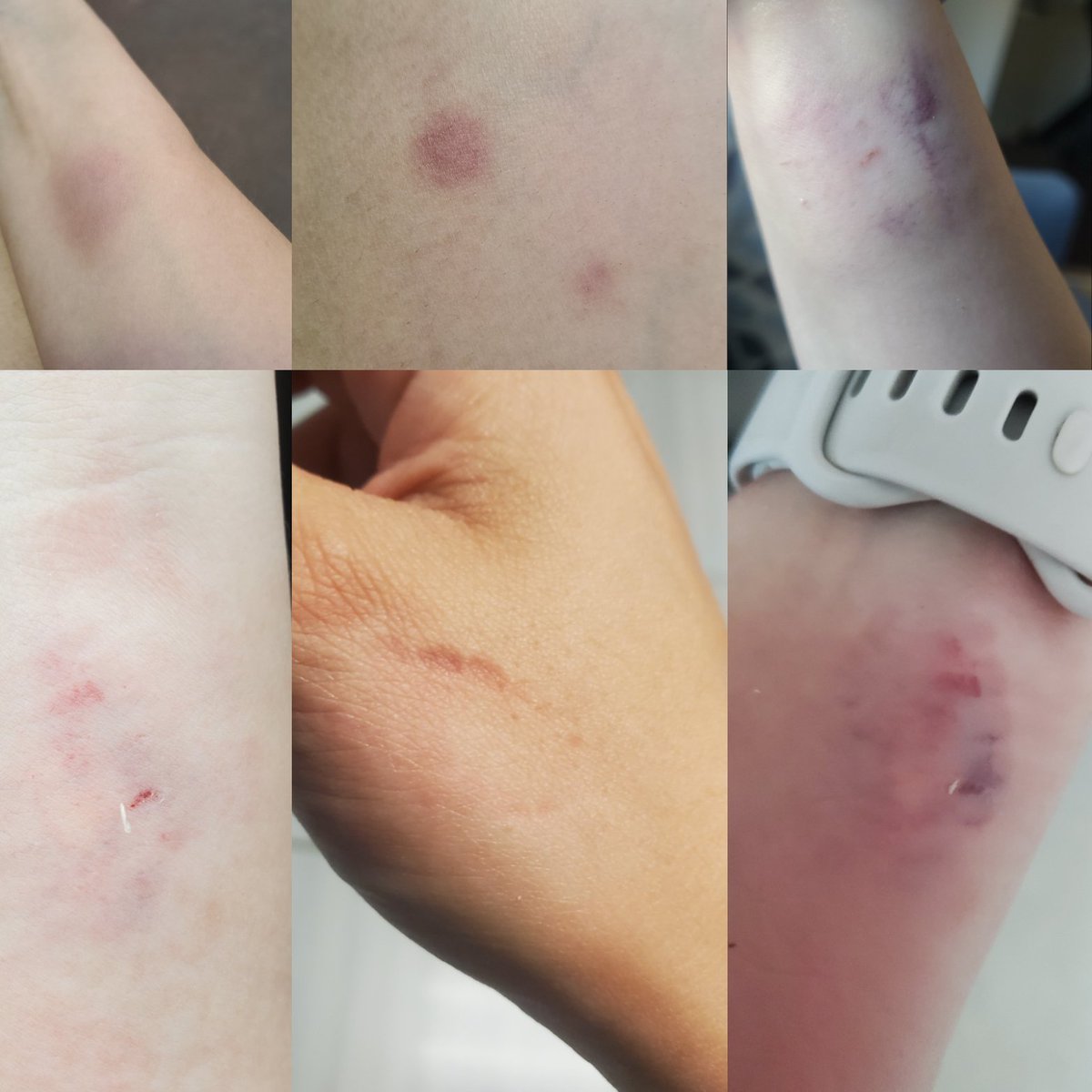 Let’s be clear:
📌 Violence is not “part of the job.”
📌 Staff should not accept being hit, bitten, or threatened.
📌 Lack of supports + lack of consequences = unsafe schools.

These are some of my injuries over the last few years.