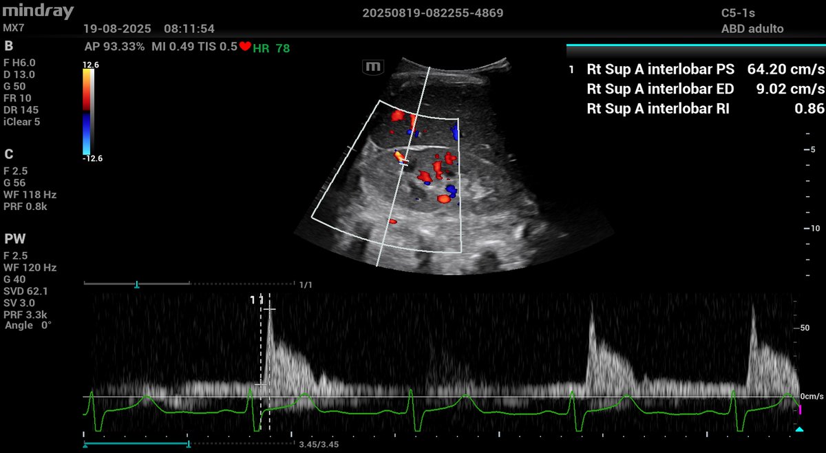 Rafael Melo (@intensivaev) on Twitter photo How do you actually use RRI? To decide early when to initiate RRT? To differentiate AKI etiology? Literature is quite controversial on this topic...<a href="/NephroP/">NephroPOCUS</a> <a href="/ArgaizR/">Eduardo R Argaiz</a> <a href="/ThinkingCC/">Philippe Rola</a> <a href="/emcrit/">the EMCrit Crew</a> How do you actually use RRI? To decide early when to initiate RRT? To differentiate AKI etiology? Literature is quite controversial on this topic...<a href="/NephroP/">NephroPOCUS</a> <a href="/ArgaizR/">Eduardo R Argaiz</a> <a href="/ThinkingCC/">Philippe Rola</a> <a href="/emcrit/">the EMCrit Crew</a>