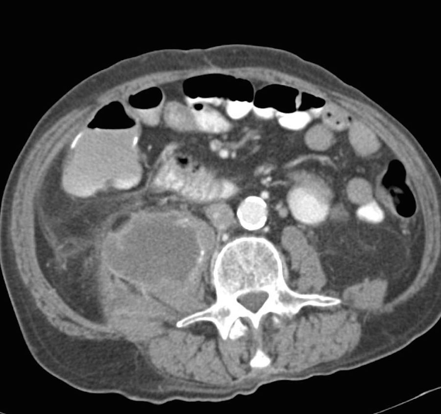 Elliot K Fishman / CTisus.com tweet media