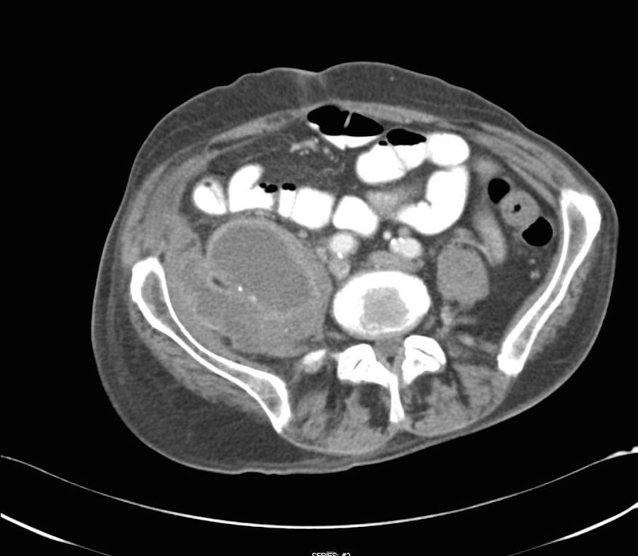 Elliot K Fishman / CTisus.com tweet media