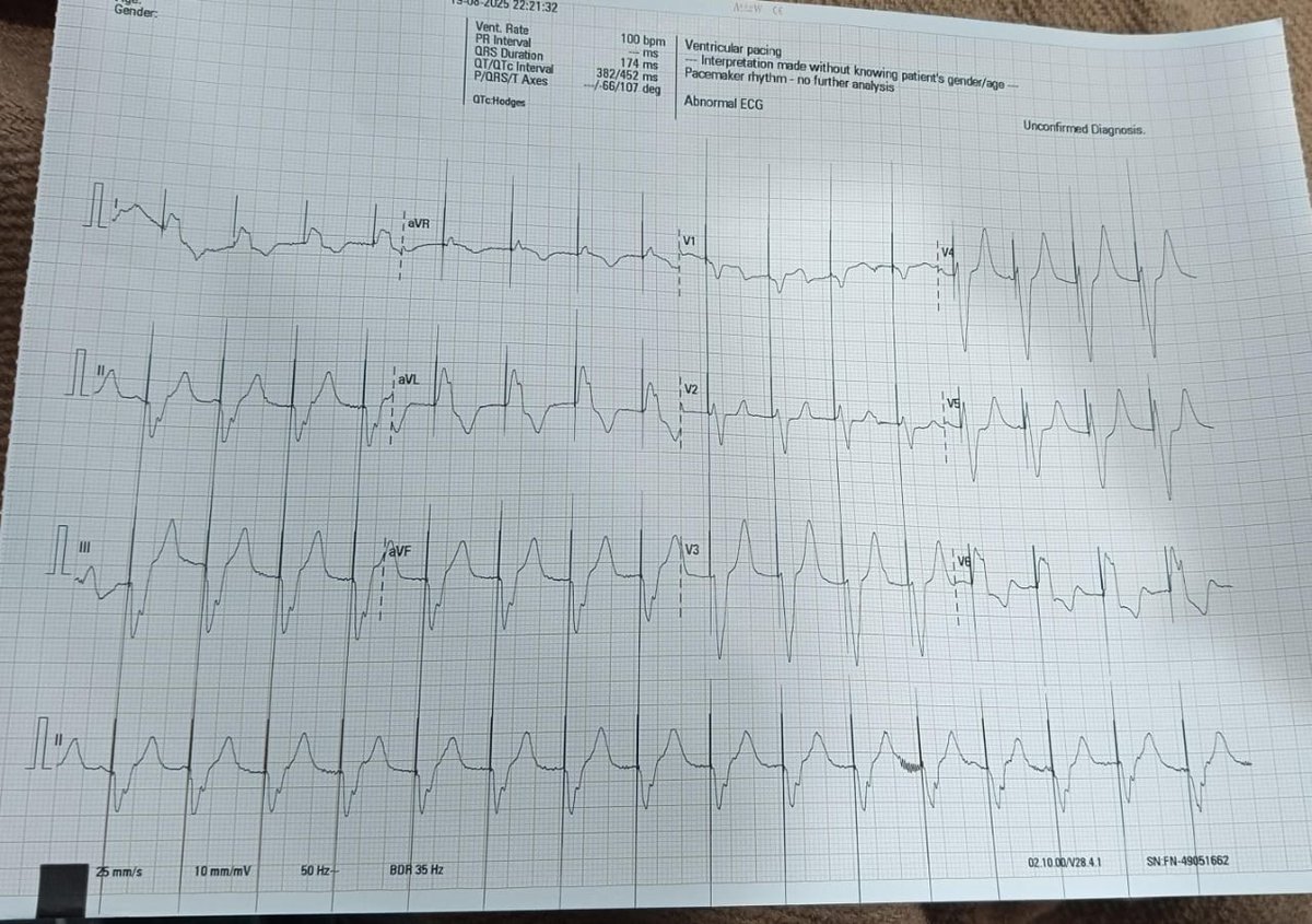 Dr Gaurav Pandey (@gauravcardio01) on Twitter photo 80 yr old patient SURVIVED... 1 . 5 HR OF JOURNEY FROM SULTANPUR TO LUCKNOW... RESILIENCE OF HEART IS JUST TOO GOOD... Now doing well post TPI... 🙏🙏Thank you Emergency staff and CATH LAB.. <a href="/wellsun/">Wellsun Medicity</a> LKO...<a href="/abadkhan2002/">Abad khan,MD/DM</a> <a href="/Drakhil_cardio/">Dr Akhil Sharma</a> <a href="/DrRajeshG1/">Dr G Rajesh (Gopalan Nair Rajesh).</a> <a href="/realarainmd/">Salman Arain</a> <a href="/Hragy/">Hany Ragy</a> 80 yr old patient SURVIVED... 1 . 5 HR OF JOURNEY FROM SULTANPUR TO LUCKNOW... RESILIENCE OF HEART IS JUST TOO GOOD... Now doing well post TPI... 🙏🙏Thank you Emergency staff and CATH LAB.. <a href="/wellsun/">Wellsun Medicity</a> LKO...<a href="/abadkhan2002/">Abad khan,MD/DM</a> <a href="/Drakhil_cardio/">Dr Akhil Sharma</a> <a href="/DrRajeshG1/">Dr G Rajesh (Gopalan Nair Rajesh).</a> <a href="/realarainmd/">Salman Arain</a> <a href="/Hragy/">Hany Ragy</a>