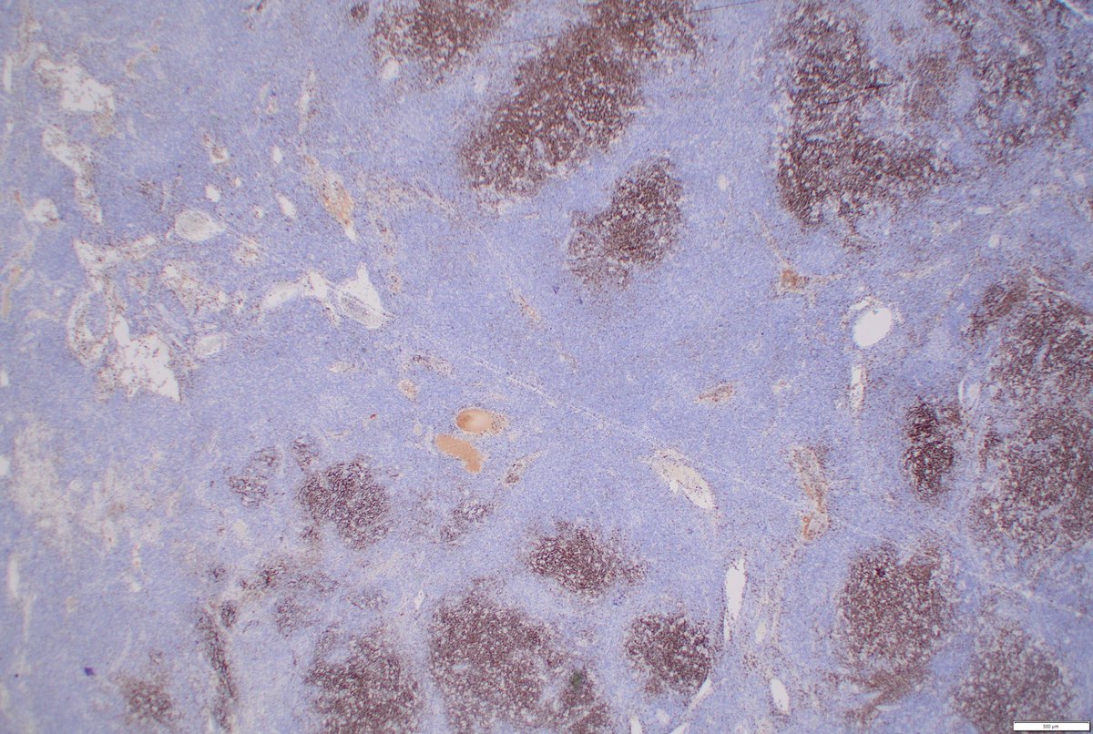 StephenStalls's tweet photo. Pelvic lymph node excision. Nodular appearance with popcorn cells. Tumor cells positive for CD45, CD20, PAX-5, MUM-1, negative for CD30, CD15. CD21, CD20, and PD-1 🌹 shown. 6 patterns described. Thoughts for entity and pattern? #PathTwitter #hemepath #pathology https://t.co/hBmajXjMYC