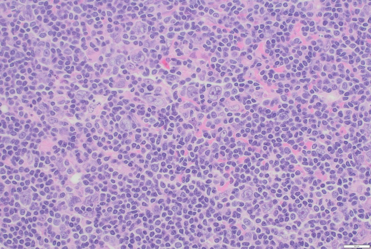 StephenStalls's tweet photo. Pelvic lymph node excision. Nodular appearance with popcorn cells. Tumor cells positive for CD45, CD20, PAX-5, MUM-1, negative for CD30, CD15. CD21, CD20, and PD-1 🌹 shown. 6 patterns described. Thoughts for entity and pattern? #PathTwitter #hemepath #pathology https://t.co/hBmajXjMYC