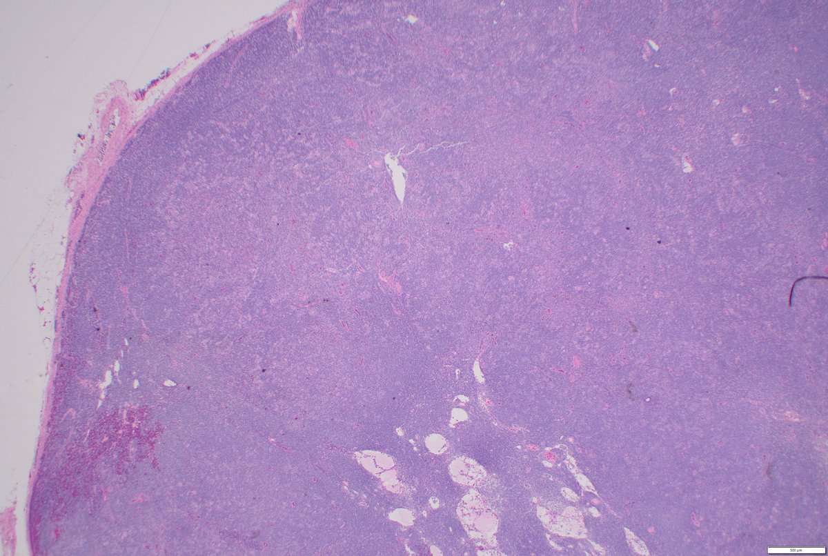 StephenStalls's tweet photo. Pelvic lymph node excision. Nodular appearance with popcorn cells. Tumor cells positive for CD45, CD20, PAX-5, MUM-1, negative for CD30, CD15. CD21, CD20, and PD-1 🌹 shown. 6 patterns described. Thoughts for entity and pattern? #PathTwitter #hemepath #pathology https://t.co/hBmajXjMYC