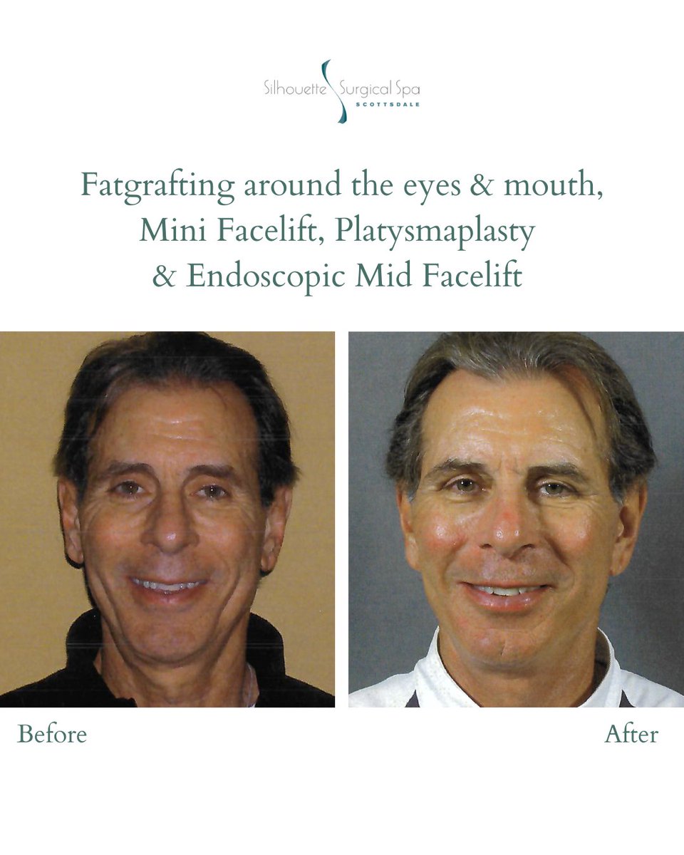 surgicalspa's tweet photo. "Facial Rejuvenation"
This patient’s transformation was achieved through a combination of advanced techniques designed to refresh and restore natural balance. 
#MaleFacelift #FaceliftScottsdale #FatGrafting #Platysmaplasty #FacialRejuvenation #SilhouetteSurgicalSpa #drptak https://t.co/jBNgnuysCT