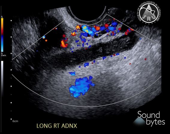 sruradiology's tweet photo. Answer to last week's case: Acute appendicitis

Case courtesy of Dr. Kate McGillen, @katelgam; Penn State Health

Note the blind-ending tubular structure in the right lower quadrant with increased vascularity. Non-compressible. Diameter of 9-13 mm

#ultrasound #RadRes https://t.co/7LZeXp2FOd