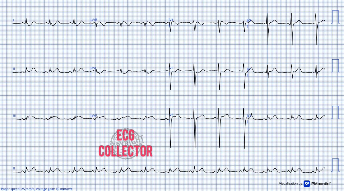 Dr Razi (@drrazi4) on Twitter photo Gentleman in 40s'; acute onset of chest pain; VS stable
What do yo thinkāš¤
<a href="/PMcardioApp/">PMcardioāAI that reads ECGs</a>
#ECG
#Cardiology
#CardioEd
#cardiotwitter
#Medicalstudent Gentleman in 40s'; acute onset of chest pain; VS stable
What do yo thinkāš¤
<a href="/PMcardioApp/">PMcardioāAI that reads ECGs</a>
#ECG
#Cardiology
#CardioEd
#cardiotwitter
#Medicalstudent