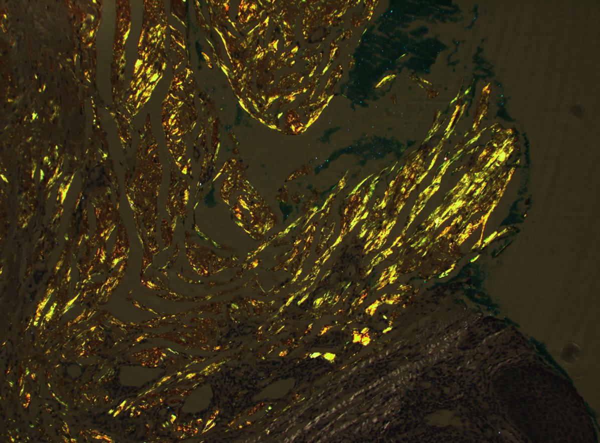 Dan Graham (@dangrahammd) on Twitter photo AMYLOID
As <a href="/GuannanTiffany/">Guannan Zhang ,张冠楠,MD, PhD</a> mentioned, solitary amyloidomas at this site are often not associated with systemic amyloidosis. However, if resources allow, amyloid subtyping by mass spec should be done to explore it. If not, skin or fat pad bxs could be done. This pt had AMYLOID
As <a href="/GuannanTiffany/">Guannan Zhang ,张冠楠,MD, PhD</a> mentioned, solitary amyloidomas at this site are often not associated with systemic amyloidosis. However, if resources allow, amyloid subtyping by mass spec should be done to explore it. If not, skin or fat pad bxs could be done. This pt had