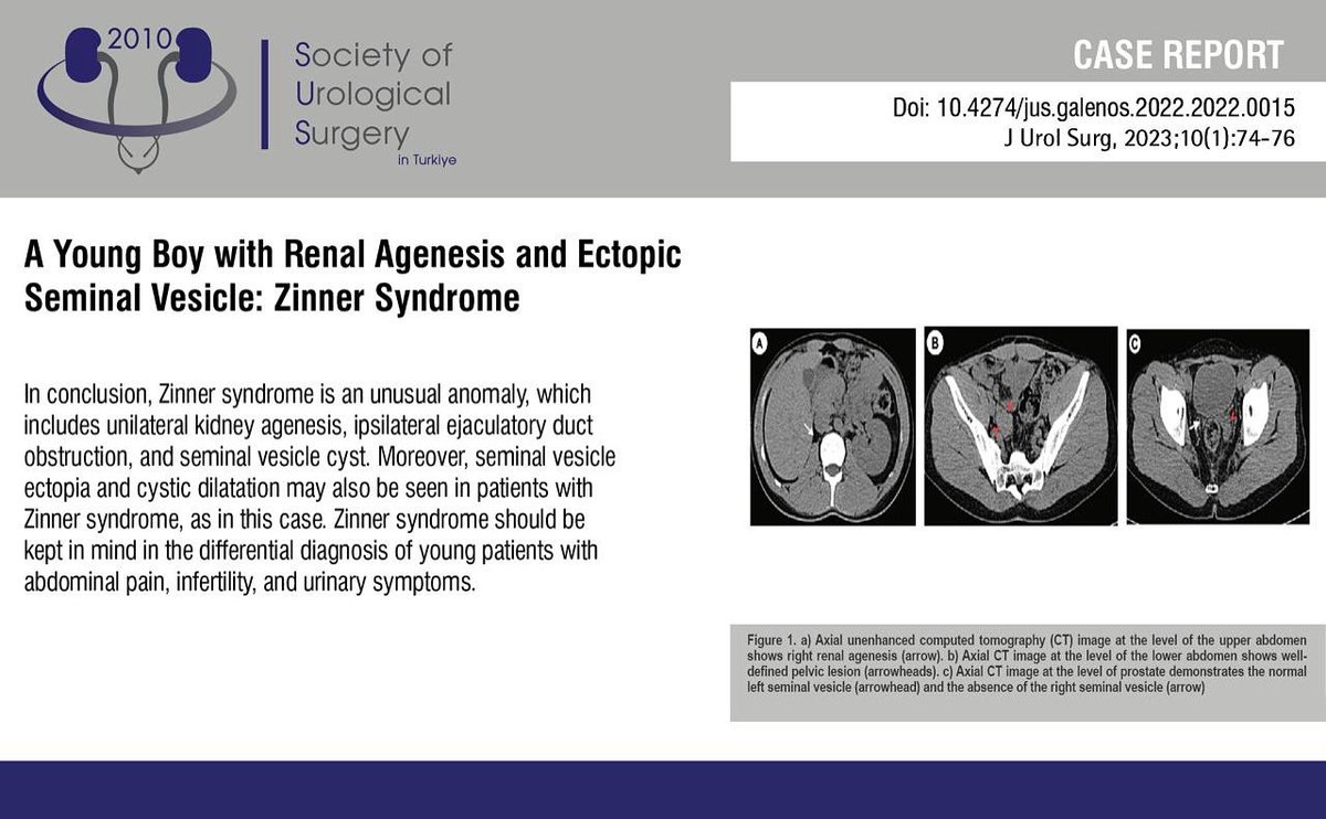 A Young Boy with Renal Agenesis and Ectopic Seminal Vesicle: ZinnerSyndrome
You can see the free full text of the research by Ahmet Yasin Yitik et al.
Link : jurolsurgery.org/articles/a-you…
 
#Imaging #congenital #malformations #renal #agenesis